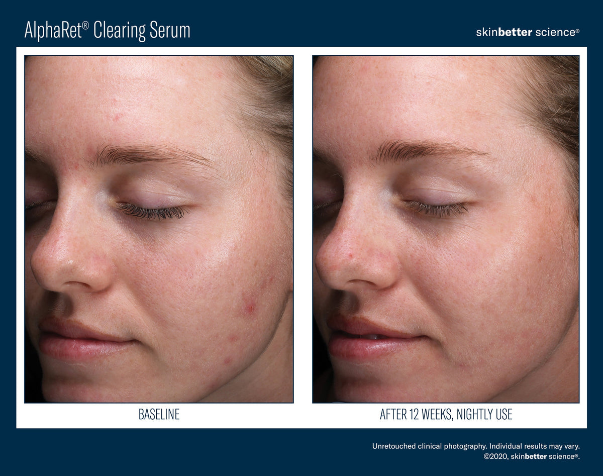 AlphaRet Clearing Serum 30 ml